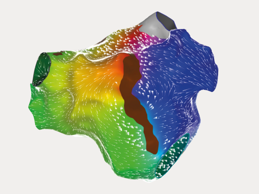 Generating Carto Map What is cardiac ablation?