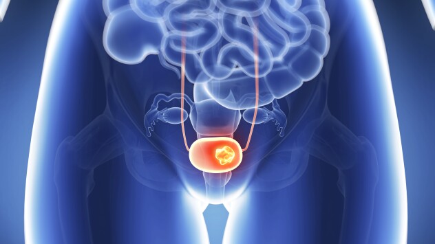 A graphic of a close-up view of bladder cancer
