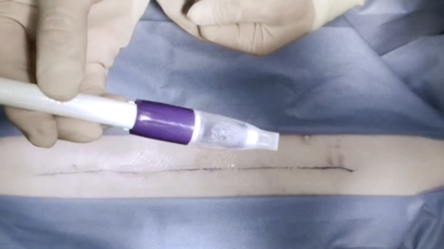 Dermabond Prineo Application Guide