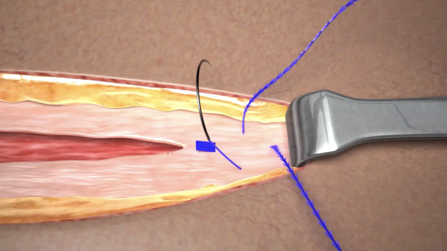 Stratafix Symmetric in Open Wound Procedures