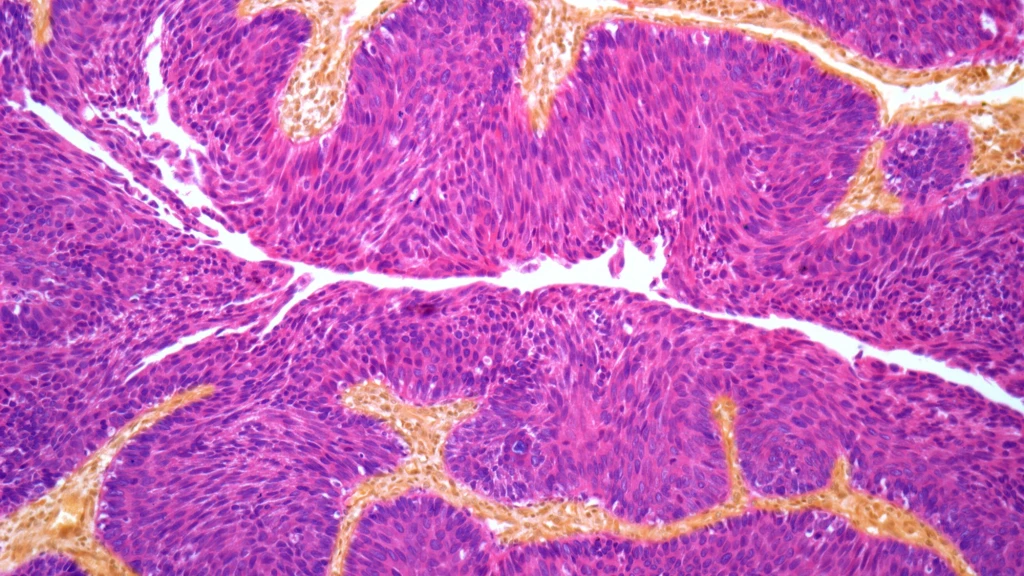Bladder cancer cells .webp