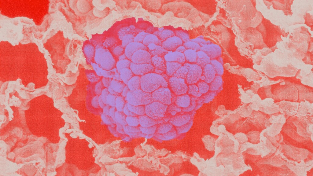 jj-bodyillustration-microscopic-lungcancer-colorway01.jpg