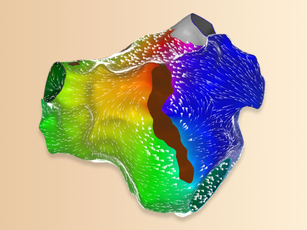 What Is Cardiac Ablation what-is-cardiac-ablation