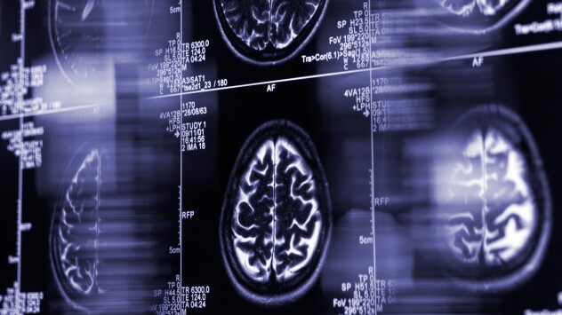 Brain scans may catch Alzheimer's disease before it starts