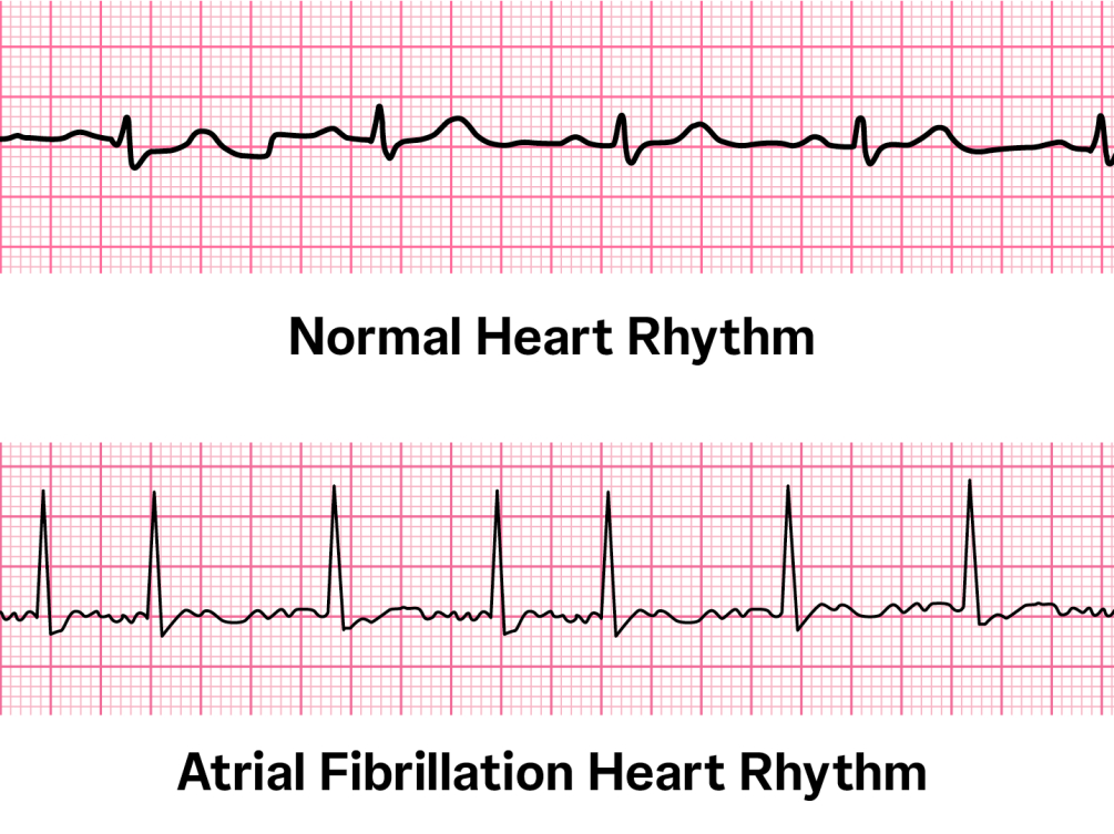 5 Things We Now Know About Atrial Fibrillation 5-things-we-now-know-about-atrial-fibrillation