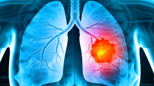 no-one-would-believe-me-when-i-suspected-i-had-lung-cancer-0923-new.jpg