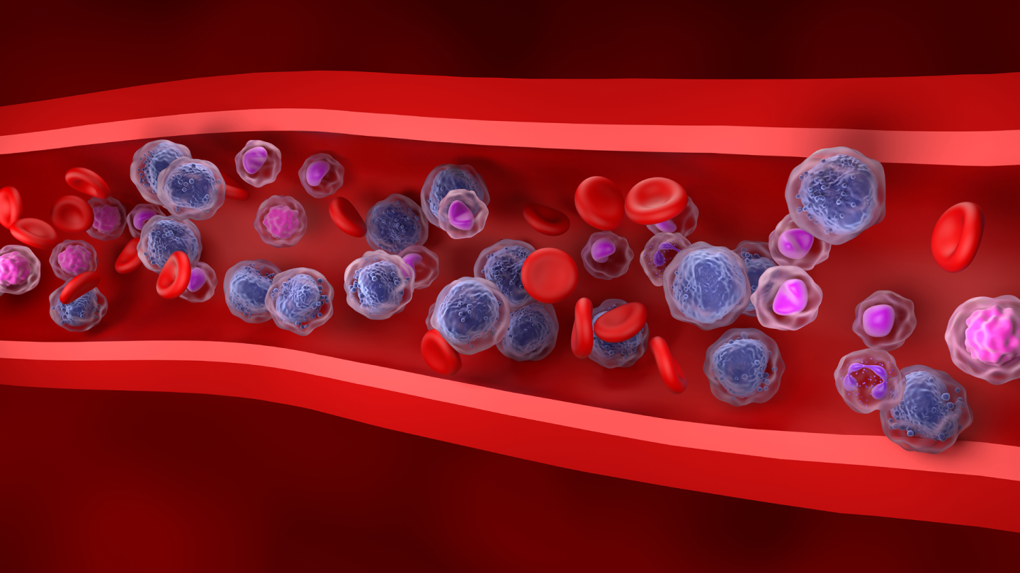 What is acute myeloid leukemia?