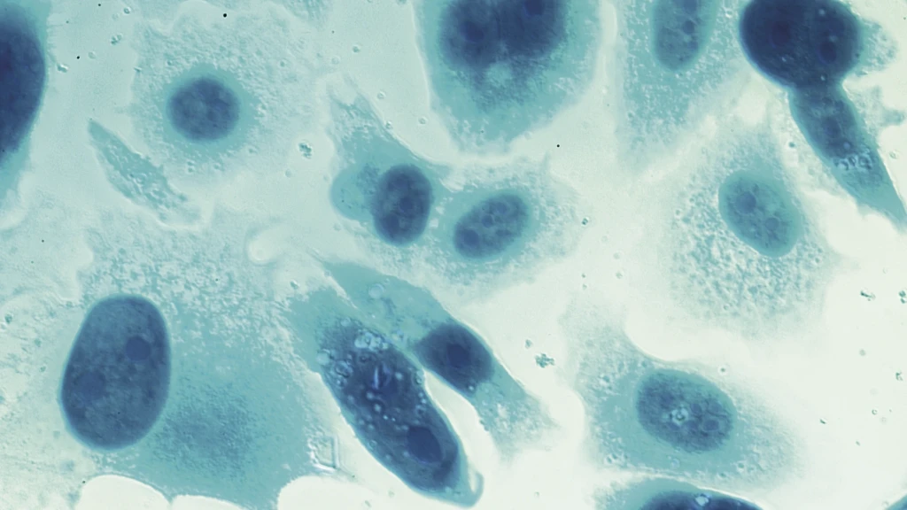 Prostate cancer cells .webp