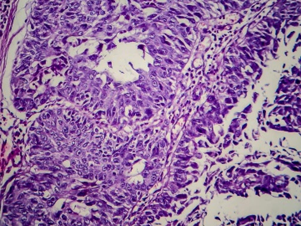 Bladder Cell Types Bladder cancer