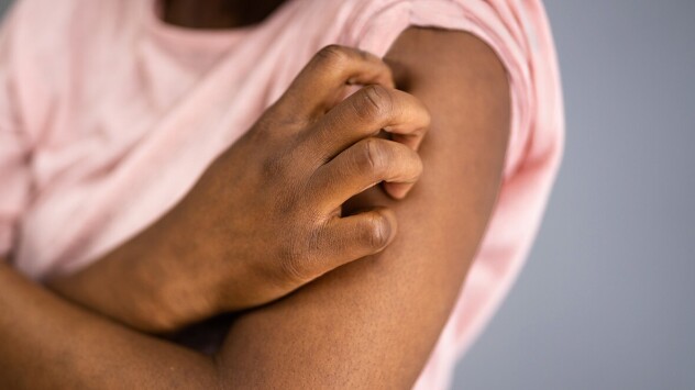 A person suffering from psoriasis scratching their arms