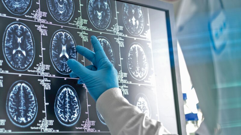Blue latex gloved hand pointing at a brain MRI scan to pinpoint brain circuits associated with depression symptoms